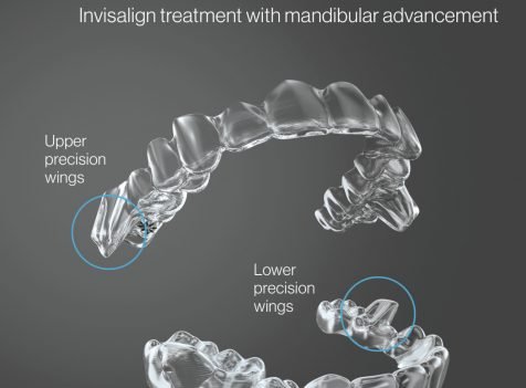 istanbul ortodontist invisalign